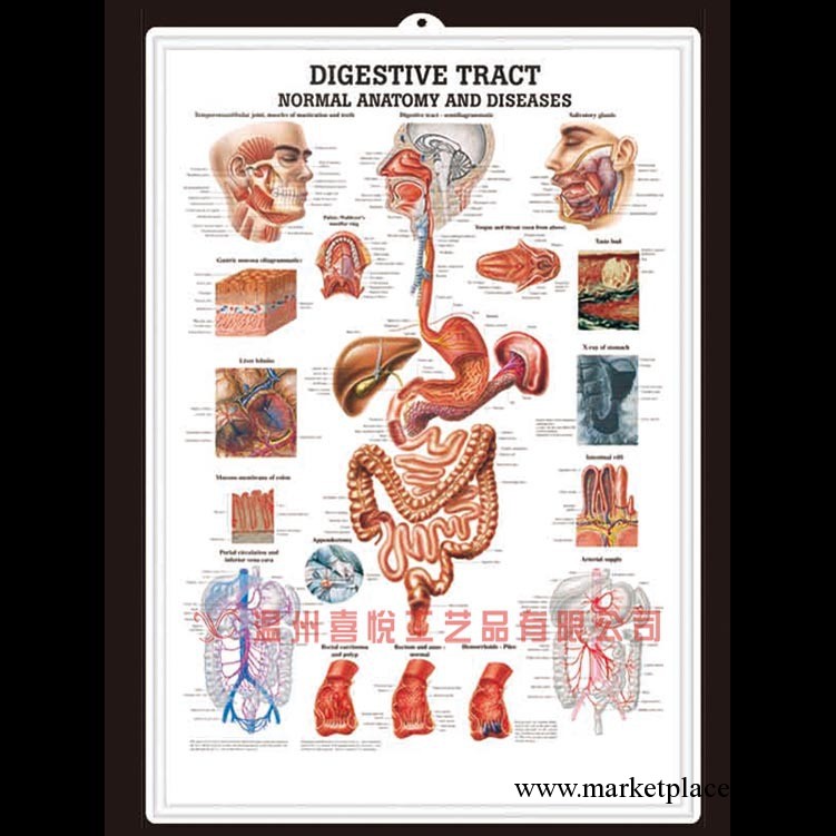 供應人體前列腺癌凹凸醫學掛圖，立體pvc吸塑海報工廠,批發,進口,代購