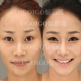 微針療法美白套裝 面部護理套裝 護膚套裝 微針套裝 化妝品套裝工廠,批發,進口,代購