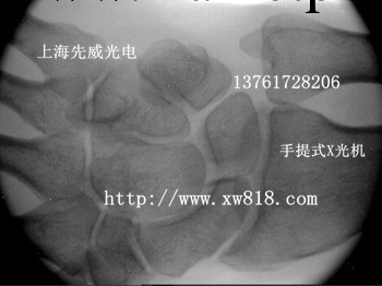 便攜式骨密度機骨密度檢測機骨齡檢測機手提式x光機工廠,批發,進口,代購