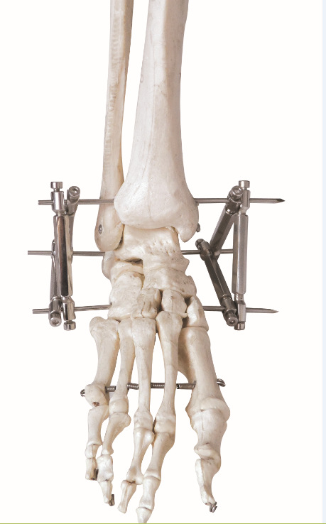 生產廠傢 骨科外固定架 骨科外固定支架 跟骨架 跟骨骨折 不銹鋼工廠,批發,進口,代購