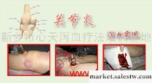 提供服務韓國瀉血標準瀉血關節炎治療工廠,批發,進口,代購