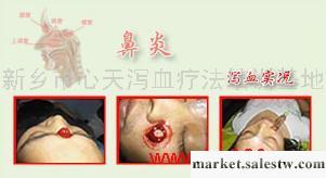 提供服務韓國瀉血正宗瀉血鼻炎治療工廠,批發,進口,代購