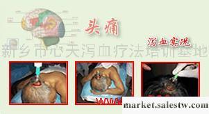 提供服務韓國瀉血正宗瀉血頭痛治療工廠,批發,進口,代購