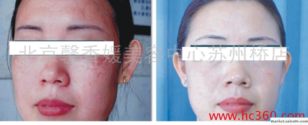 供應北京朝陽區豐臺管莊脫毛去眼袋瘦臉溶脂隆鼻豐下巴減肥效果好工廠,批發,進口,代購